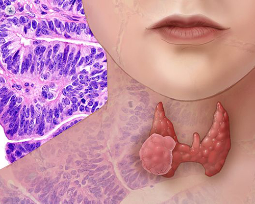 Thyroid Cancers